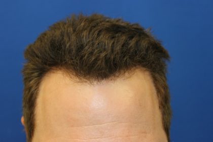 Hair Restoration Before & After Patient #5711