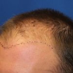 Hair Restoration Before & After Patient #5786