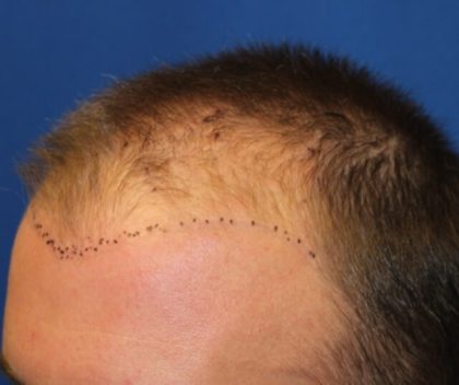 Hair Restoration Before & After Patient #5786