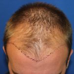 Hair Restoration Before & After Patient #5786