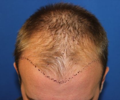 Hair Restoration Before & After Patient #5786