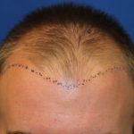 Hair Restoration Before & After Patient #5786