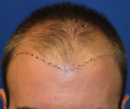 Hair Restoration Before & After Patient #5786