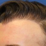 Hair Restoration Before & After Patient #5786