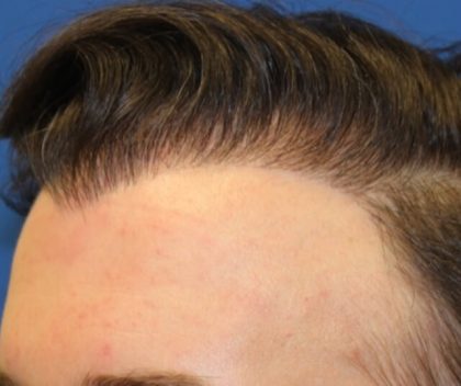 Hair Restoration Before & After Patient #5786