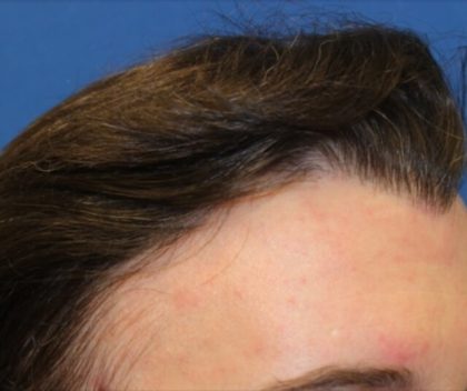 Hair Restoration Before & After Patient #5786