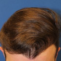 Hair Restoration Before & After Patient #5786