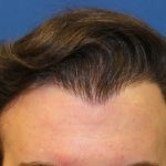 Hair Restoration Before & After Patient #5786