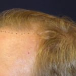 Hair Restoration Before & After Patient #5795