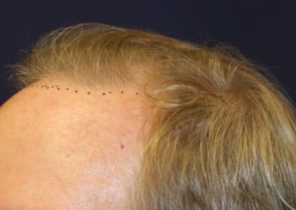 Hair Restoration Before & After Patient #5795