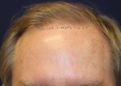 Hair Restoration Before & After Patient #5795