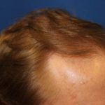 Hair Restoration Before & After Patient #5795