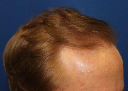 Hair Restoration Before & After Patient #5795