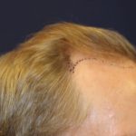 Hair Restoration Before & After Patient #5795