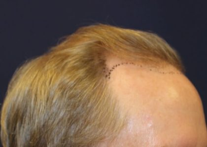 Hair Restoration Before & After Patient #5795