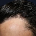 Hair Restoration Before & After Patient #5802