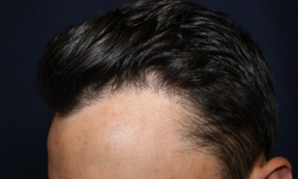 Hair Restoration Before & After Patient #5802