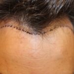 Hair Restoration Before & After Patient #5802