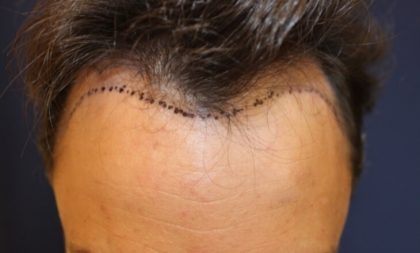 Hair Restoration Before & After Patient #5802