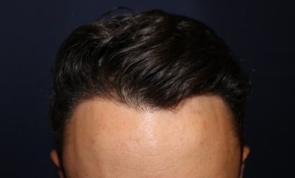 Hair Restoration Before & After Patient #5802