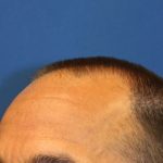 Hair Restoration Before & After Patient #5727