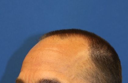 Hair Restoration Before & After Patient #5727