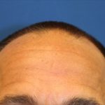 Hair Restoration Before & After Patient #5727