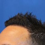 Hair Restoration Before & After Patient #5727