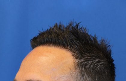 Hair Restoration Before & After Patient #5727