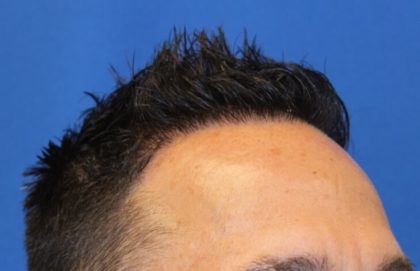 Hair Restoration Before & After Patient #5727