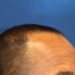 Hair Restoration Before & After Patient #5727