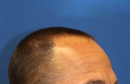 Hair Restoration Before & After Patient #5727