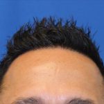 Hair Restoration Before & After Patient #5727