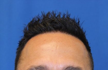 Hair Restoration Before & After Patient #5727