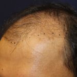 Hair Restoration Before & After Patient #5718