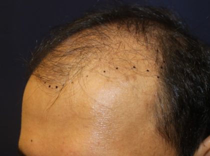 Hair Restoration Before & After Patient #5718