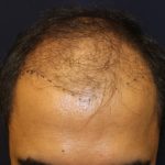 Hair Restoration Before & After Patient #5718