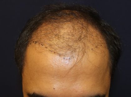 Hair Restoration Before & After Patient #5718
