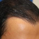 Hair Restoration Before & After Patient #5718