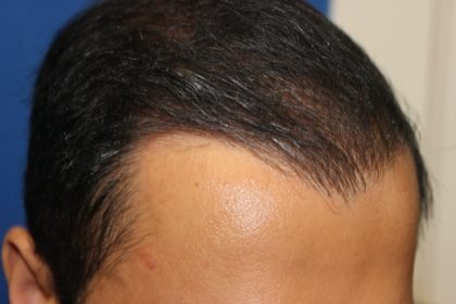 Hair Restoration Before & After Patient #5718