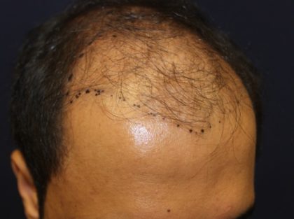 Hair Restoration Before & After Patient #5718