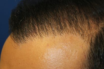 Hair Restoration Before & After Patient #5718