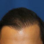 Hair Restoration Before & After Patient #5718