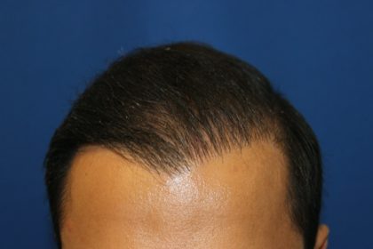 Hair Restoration Before & After Patient #5718