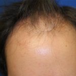 Hair Restoration Before & After Patient #5859