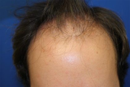 Hair Restoration Before & After Patient #5859