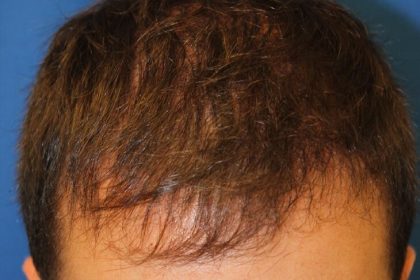 Hair Restoration Before & After Patient #5859