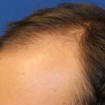 Hair Restoration Before & After Patient #5859