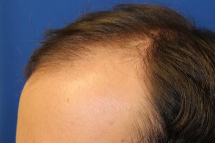 Hair Restoration Before & After Patient #5859