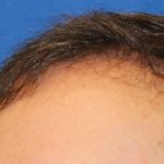 Hair Restoration Before & After Patient #5859